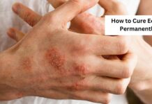 How to Cure Eczema Permanently?