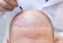 From Fitness Supplements to Protein Powders – Are They Secretly Causing Your Hair Loss?